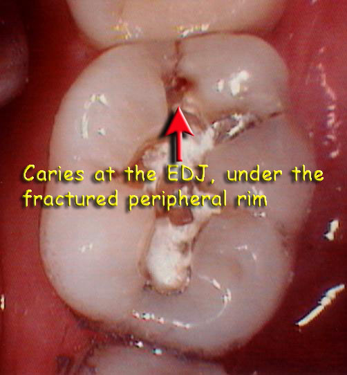 Occlusal effect5.2web3.jpg